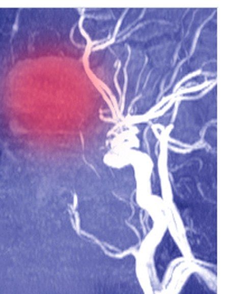 Vascular imaging post